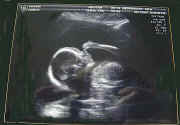 6-12-07ultrasound.jpg (32234 bytes)